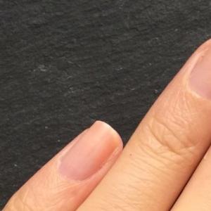 Γιατί εμφανίζονται βαθουλώματα στα νύχια Αιτίες λακκούβων στα νύχια